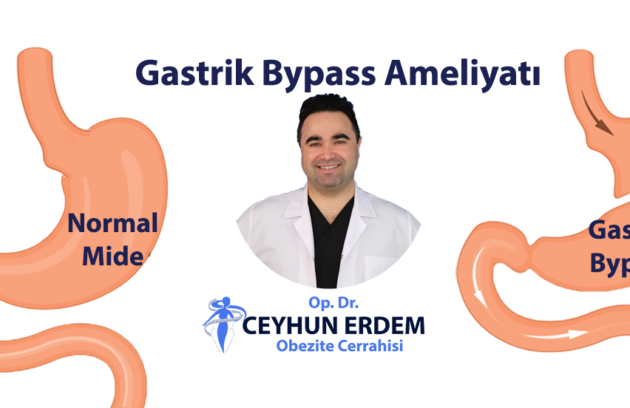 Gastrik bypass, Gastrik bypass fiyat, Gastrik bypass sonrası, Gastrik bypass ameliyatı kaç saat sürer, Gastrik bypass ameliyatı sonrası beslenme, Gastrik bypass ameliyatı nasıl yapılır, Gastrik bypass ameliyatı olanlar, Gastrik bypass ameliyatı sonrası Gastrik bypass ameliyatı fiyatı