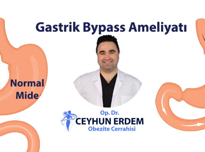 Gastrik bypass, Gastrik bypass fiyat, Gastrik bypass sonrası, Gastrik bypass ameliyatı kaç saat sürer, Gastrik bypass ameliyatı sonrası beslenme, Gastrik bypass ameliyatı nasıl yapılır, Gastrik bypass ameliyatı olanlar, Gastrik bypass ameliyatı sonrası Gastrik bypass ameliyatı fiyatı