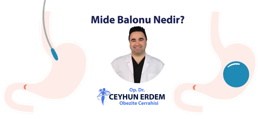 Mide Balonu