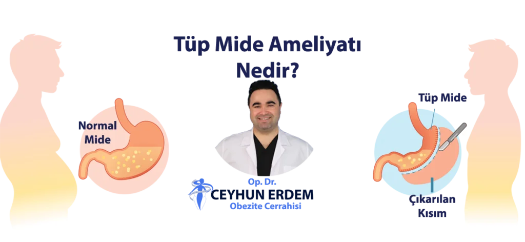 Tüp Mide Ameliyatı