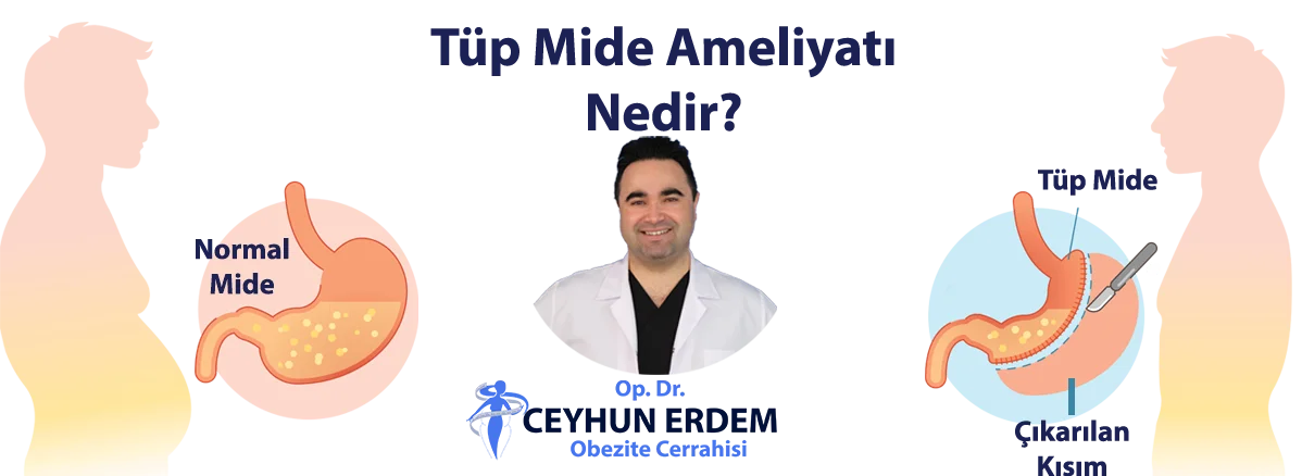tüp mide ameliyatı, tüp mide ameliyatı nedir, tüp mide ameliyatı fiyatı, tüp mide ameliyatı sonrası