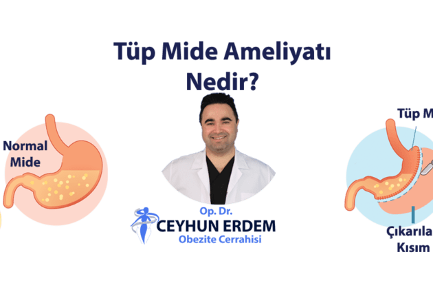 tüp mide ameliyatı, tüp mide ameliyatı nedir, tüp mide ameliyatı fiyatı, tüp mide ameliyatı sonrası