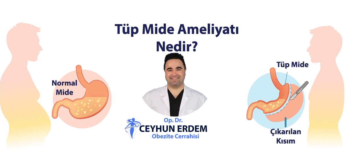 Tüp Mide Ameliyatı