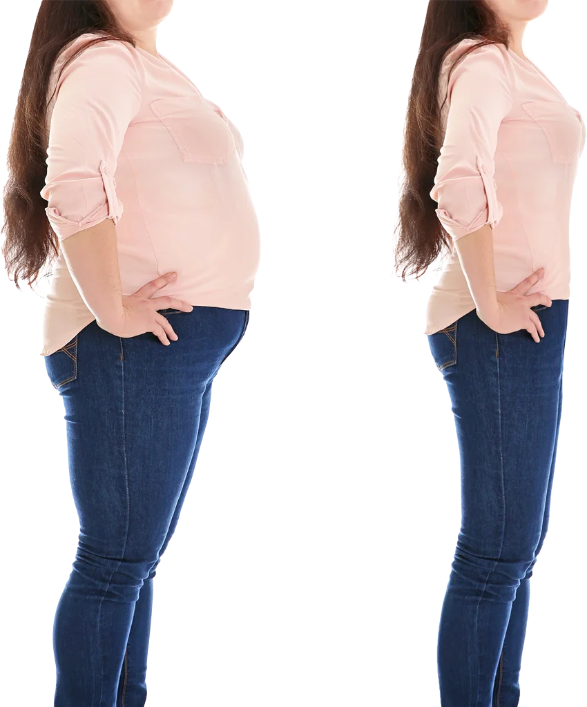 obezite nedir, öncesi sonrası, obezite cerrahisi