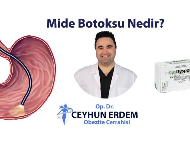 Mide botoksu, Mide botoksu nedir, Mide botoksu fiyat, Mide botoksu sonrası beslenme, Mide botoksu yaptıranlar, Mide botoksu nasıl yapılır
