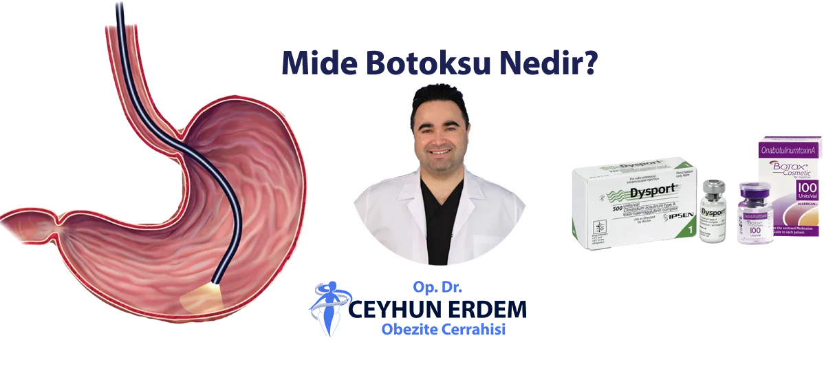 Mide botoksu, Mide botoksu nedir, Mide botoksu fiyat, Mide botoksu sonrası beslenme, Mide botoksu yaptıranlar, Mide botoksu nasıl yapılır